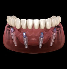 Multiple-Implants