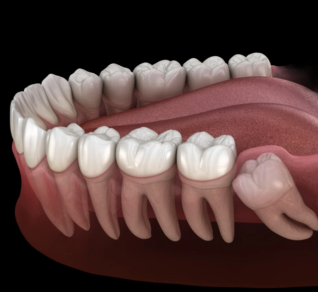 Lilburn Smile Makers Dental provides wisdom teeth removal treatment in Lilburn, Georgia