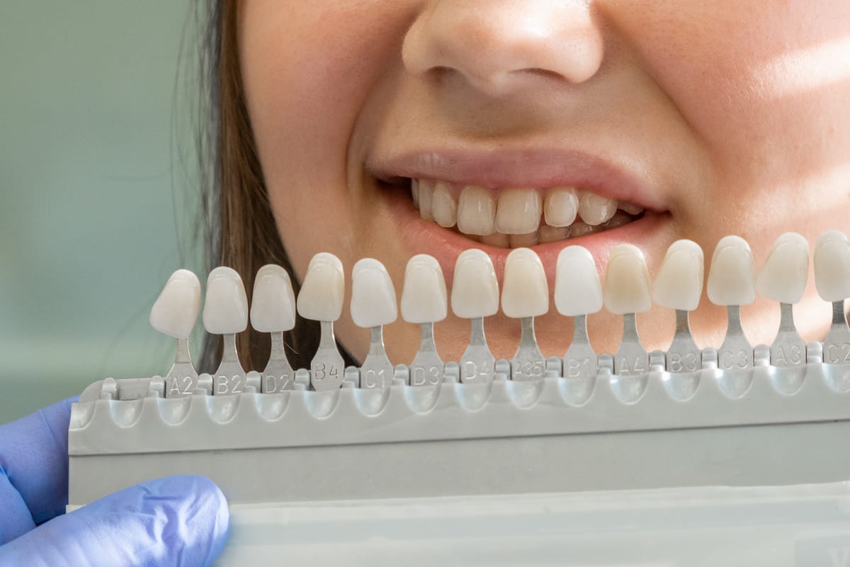 Veneers in Lilburn