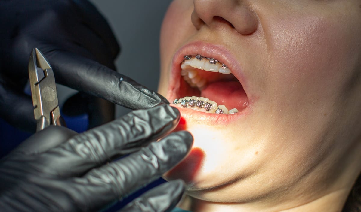Dental Bridges in Mooresville