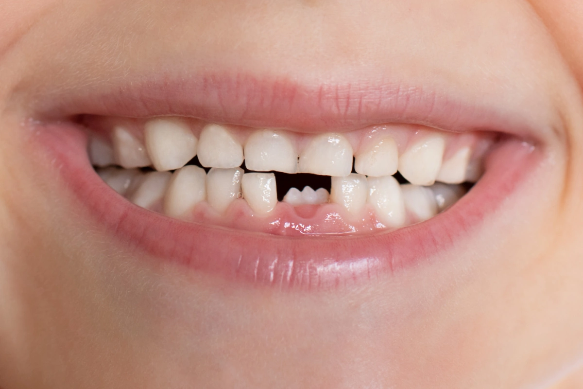 Filling in the Gaps: Your Options for Missing Teeth | Dentist in Sugar Land