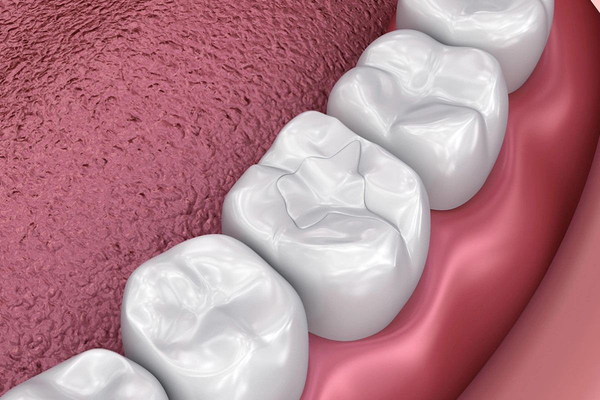 Tooth-Colored Fillings: Aesthetic and Durable Cavity Solutions