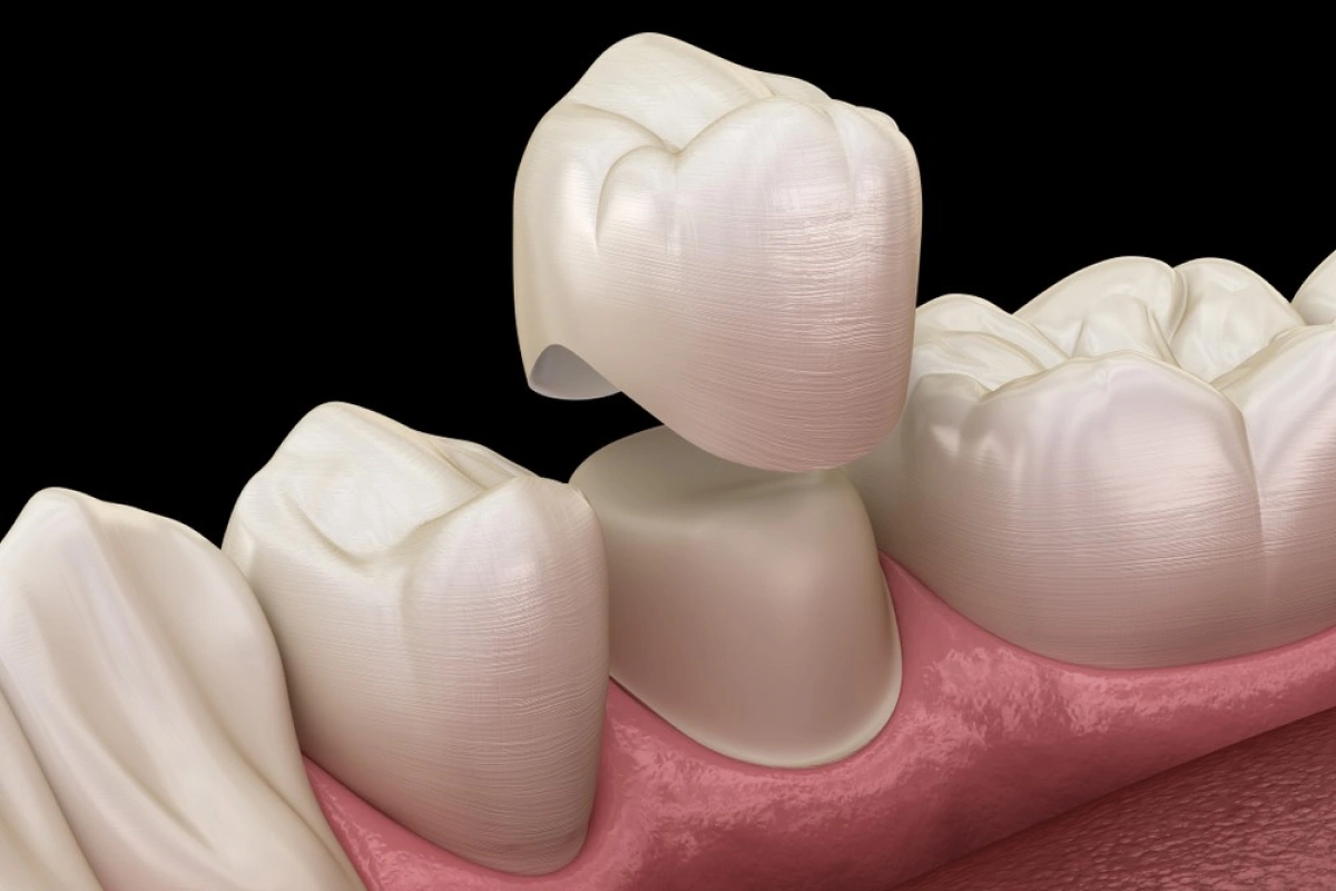 Understanding Dental Crowns: When and Why They Are Necessary