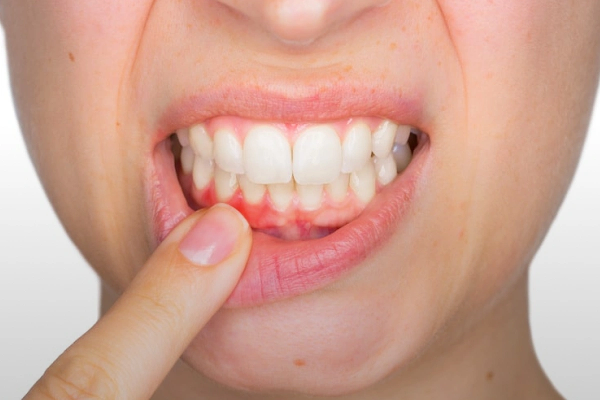 Gum Maintenance Therapy: How It Helps Prevent Gum Disease