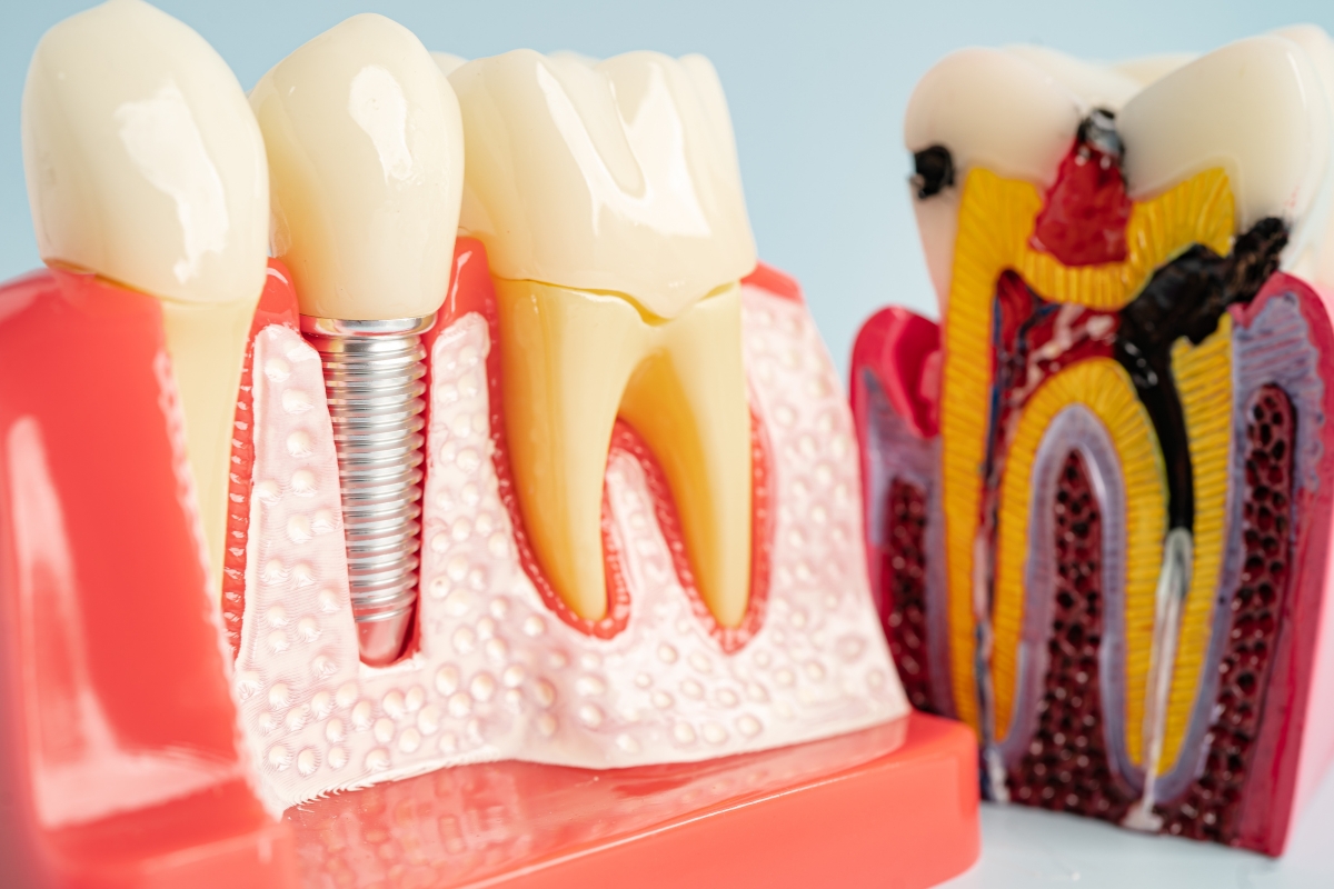 Why Zirconia Implants Are the Future of Holistic Cosmetic Dentistry