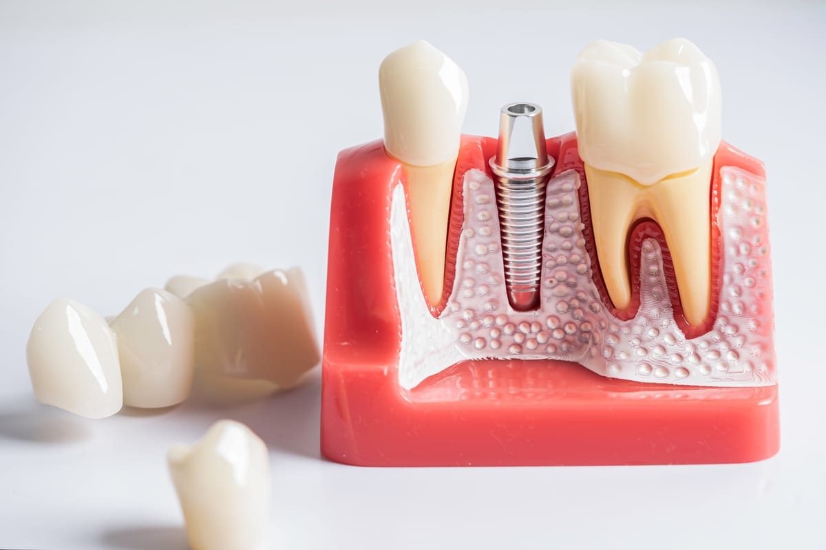 Dental Implants in Greatwood