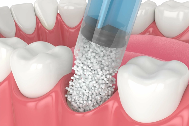 procedures before getting dental implants at lux smiles