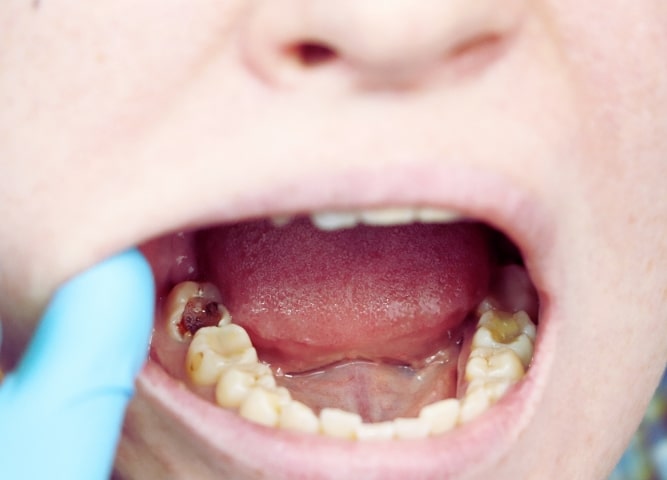 what are dental cavities