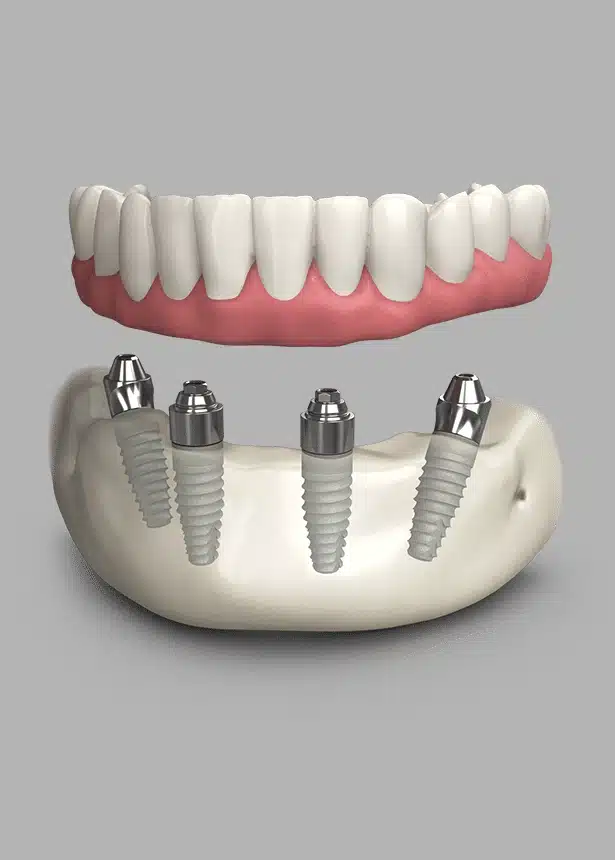 all on 4 implants at lux smiles