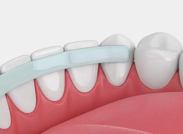 cosmetic bonding procedures at lux smiles