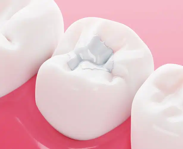 Flawless smile in Chicago il with tooth-colored fillings