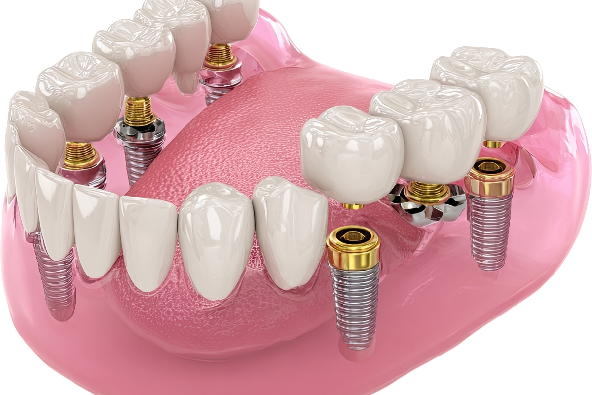 All-On-4-implants-in-Chicago