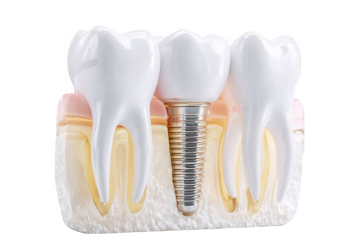 Single-Tooth-Implants