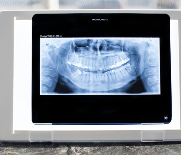 Digital X-rays