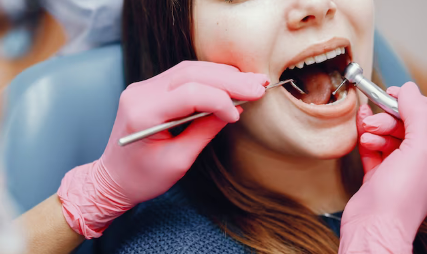 Composite fillings