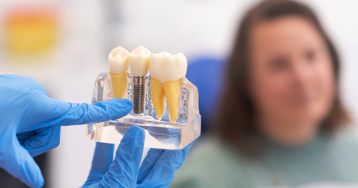 When Dental Implants Go - Miel Dental Peabody Aesthetics