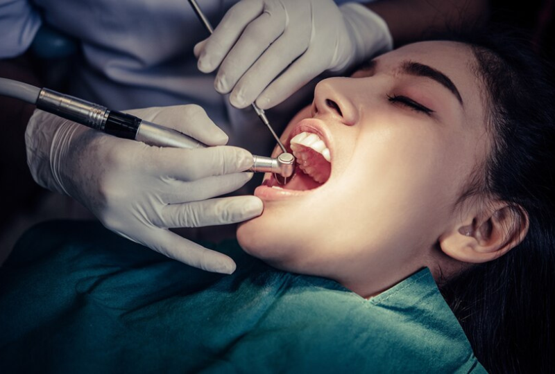 How Composite Filings Revolutionize Tooth Decay Prevention