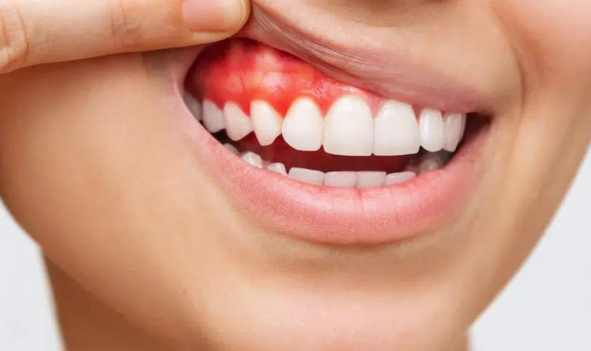 Bleeding Gums: Don't Panic! Here's What You Need to Know