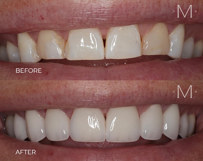Before and After