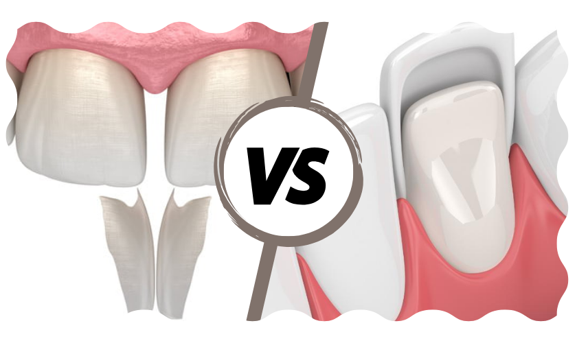 Composite Bonding vs Veneers