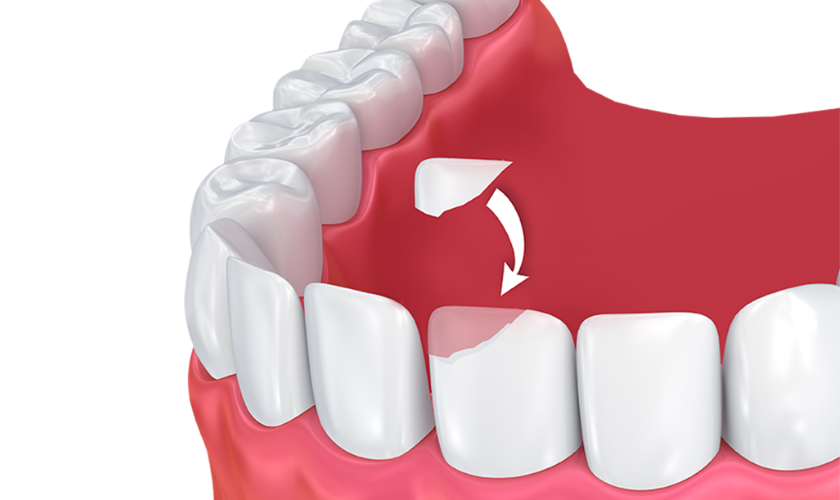 Composite Bonding