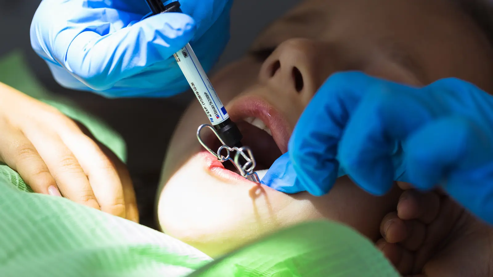 How Painful Is Tooth Extraction Without Anesthesia
