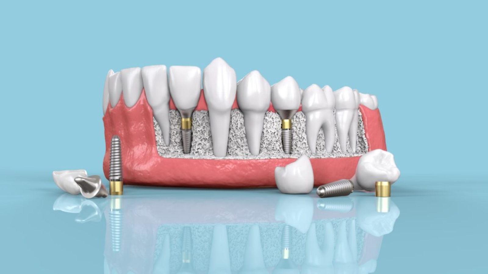 Your Week-by-Week Guide to Dental Implant Healing