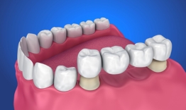dental bridge aftercare tips for a smooth recovery in peabody