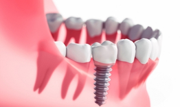 key factors to consider for dental implants