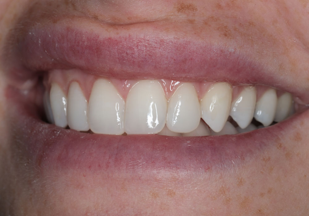 smile teeth