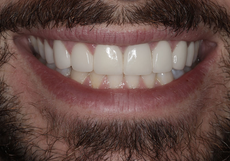 smile after