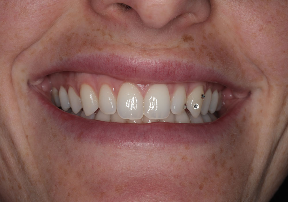 smile teeth