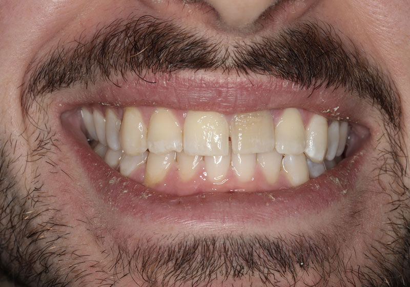 smile before