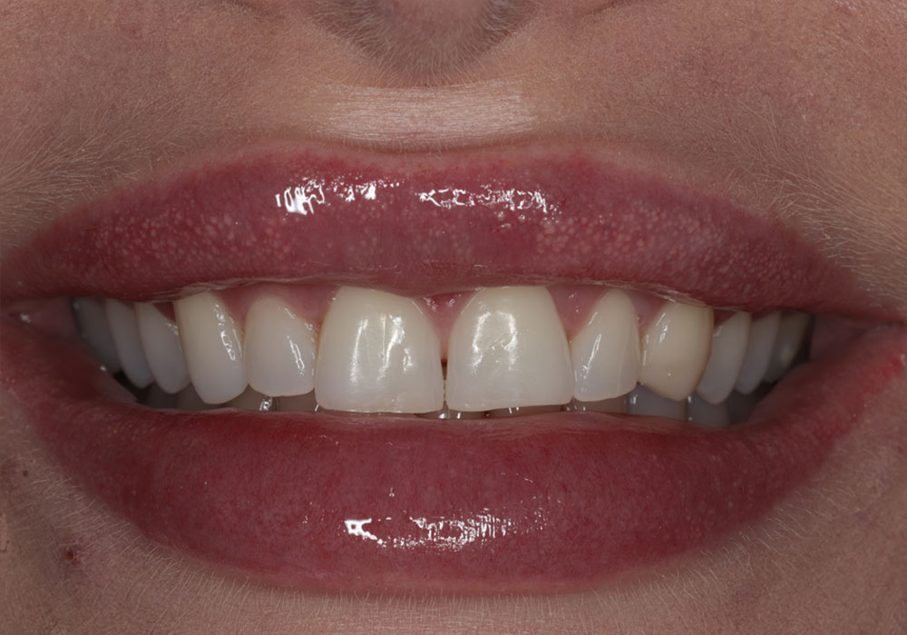 smile teeth