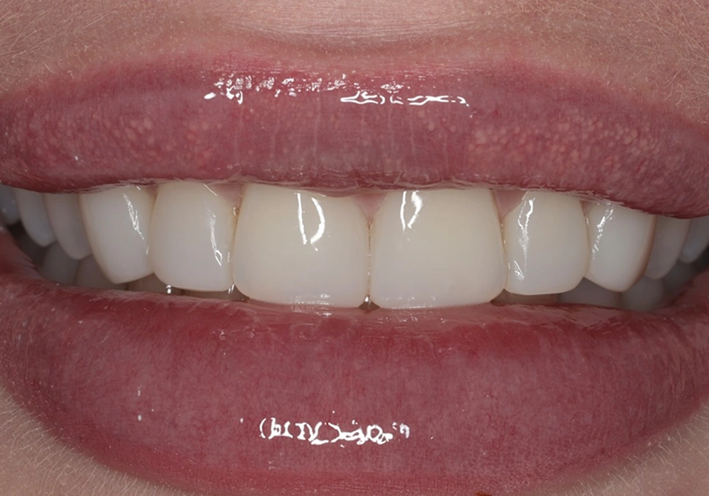 smile tooth before after