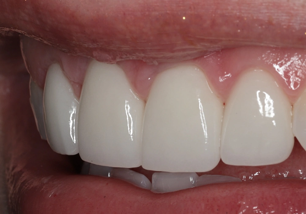 smile teeth after
