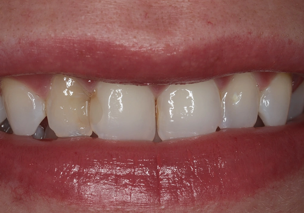 smile teeth before