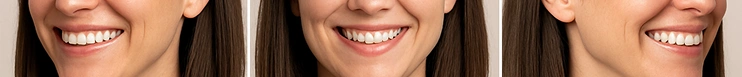 Front smile view Left-side smile view Right side smile view smile face