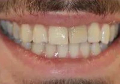 before Teeth