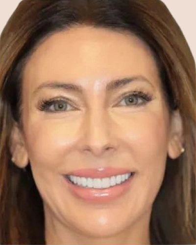 after Teeth