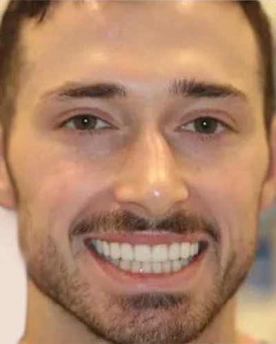 after smile
