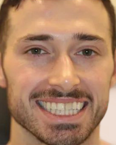 before smile