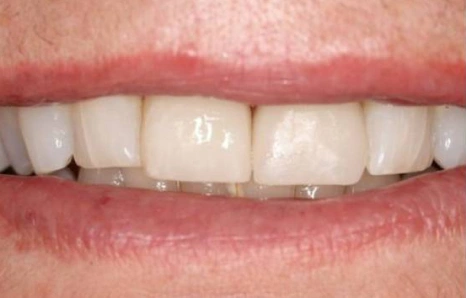 Img-before-and-after - AFTER 1