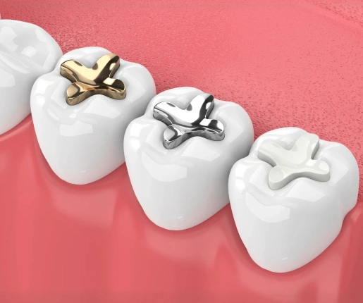 composite-fillings