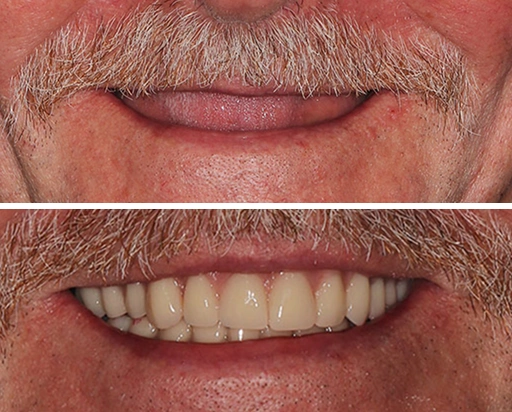 Custom Dentures