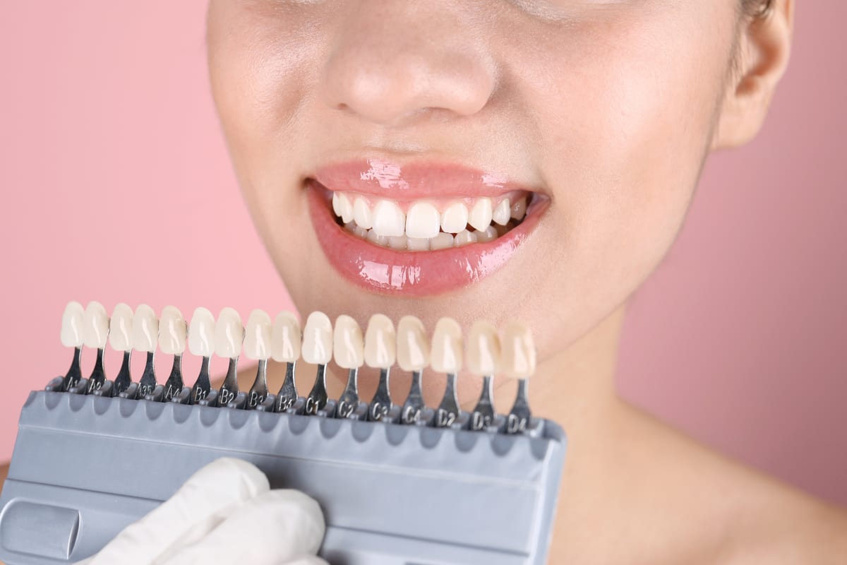 Veneers in Mobile