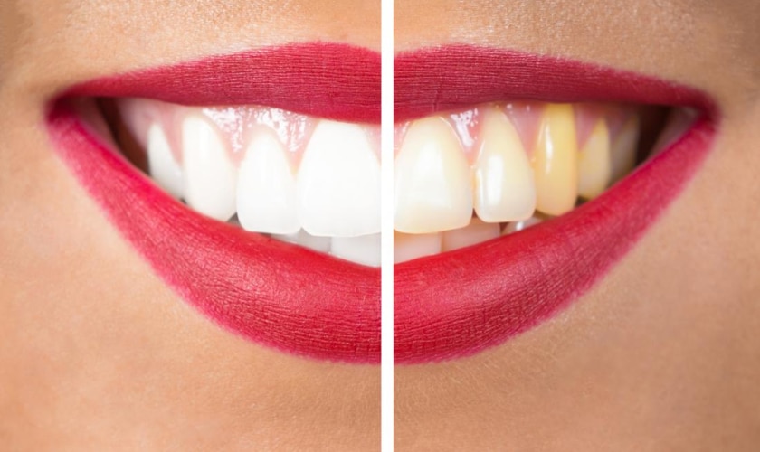 Prevent Yellowing Teeth and Maintain Oral Health