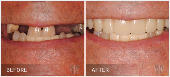 dental-full-mouth-implant