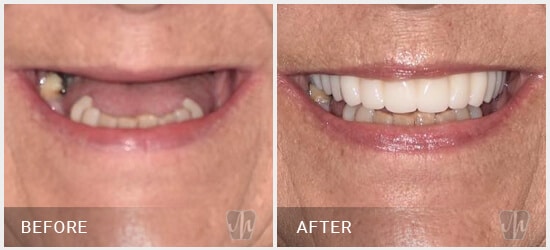 dental-full-mouth-implant