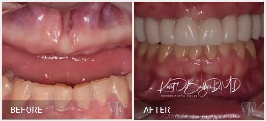 dental-full-mouth-implant